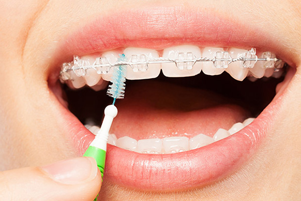 Invisalign-vs-clear-ceramic-braces - Simply Dental