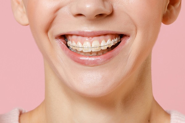 How Clear Braces Can Give You Straighter Teeth - Oak Tree Dental ...