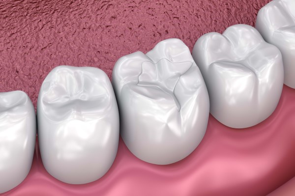 Three Questions To Ask Your Dentist About White Dental Fillings